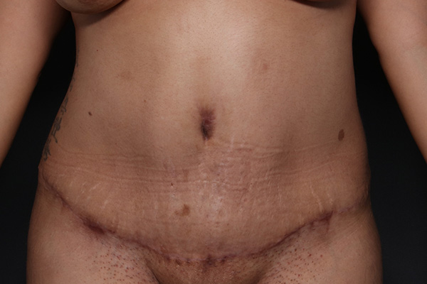 Abdominoplasty Before and After | Larson Plastic Surgery
