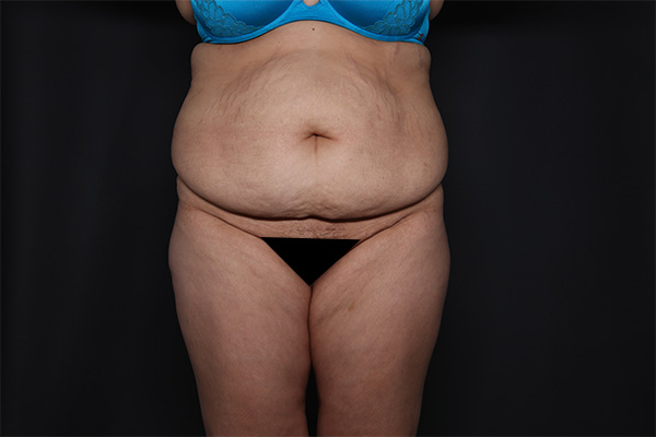 Abdominoplasty Before and After | Larson Plastic Surgery