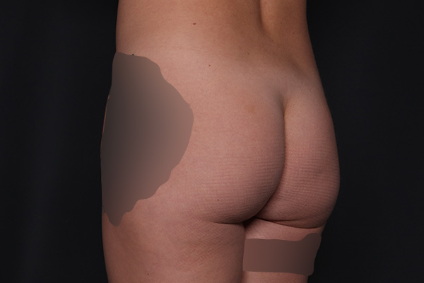 Brazilian Butt Lift Before and After | Larson Plastic Surgery