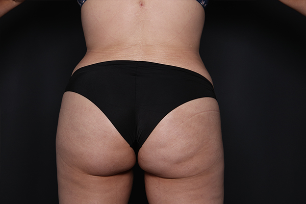 Brazilian Butt Lift Before and After | Larson Plastic Surgery