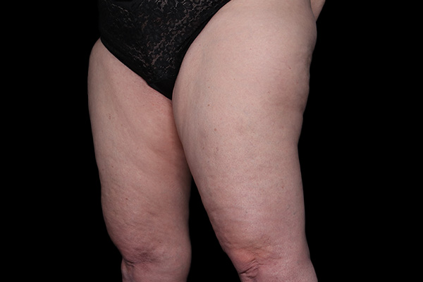 Lipedema Before and After | Larson Plastic Surgery