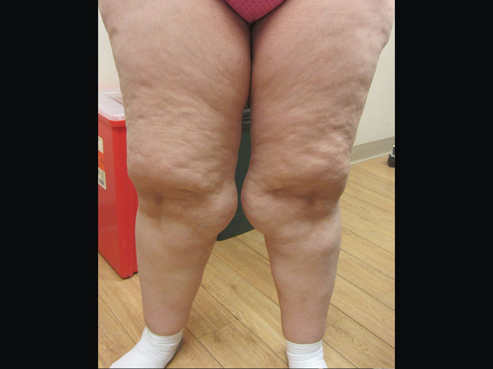 Lipedema Before and After | Larson Plastic Surgery