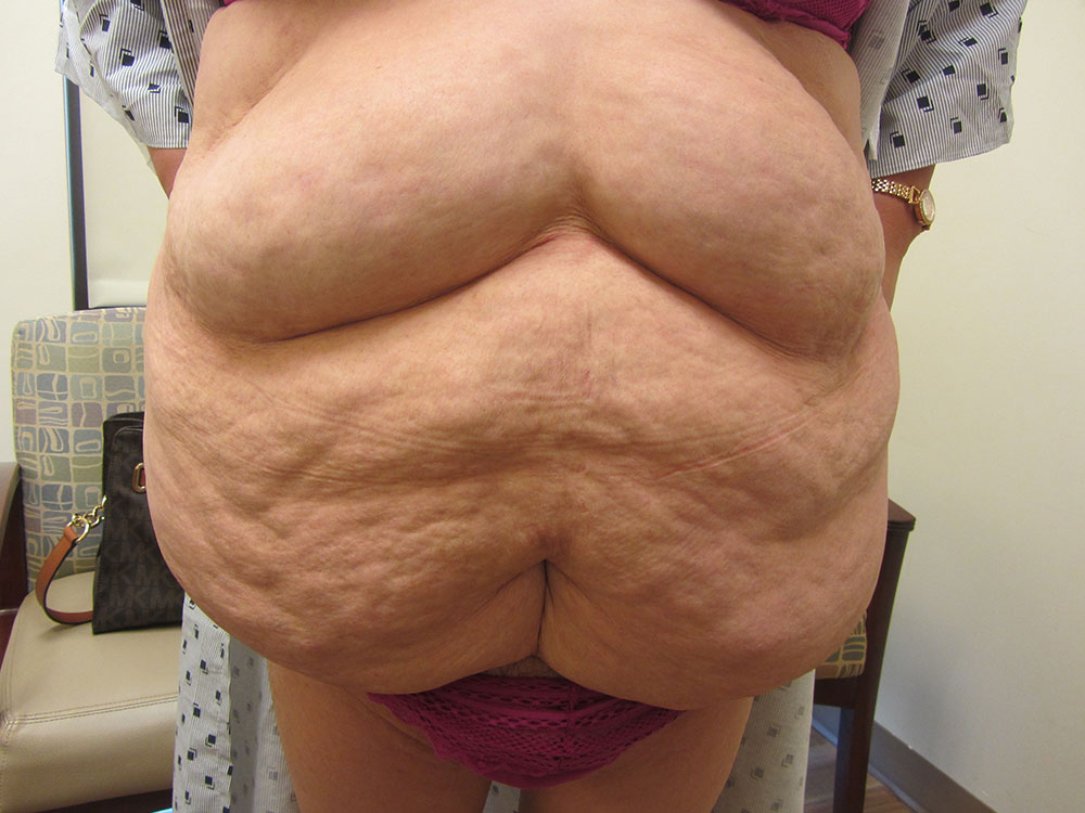 Abdominoplasty Tucson