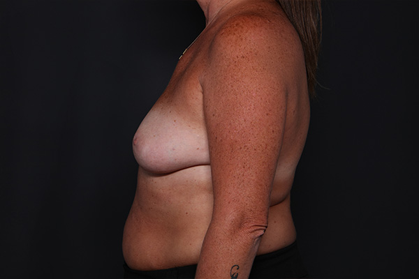 Breast Augmentation Before and After | Larson Plastic Surgery