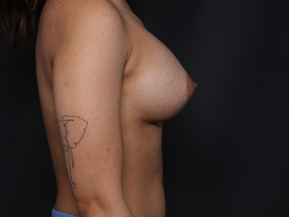Breast Augmentation Before and After | Larson Plastic Surgery