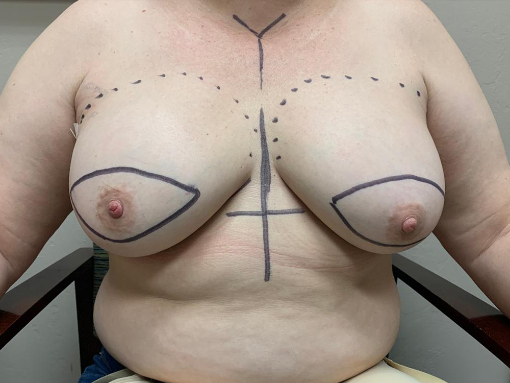 Breast Reconstruction Before and After | Larson Plastic Surgery