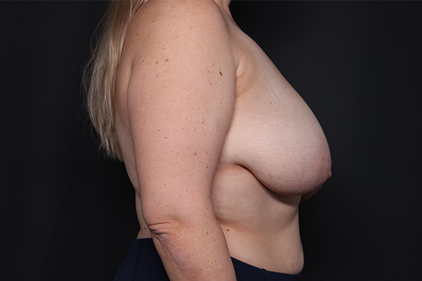 Breast Reduction Before and After | Larson Plastic Surgery