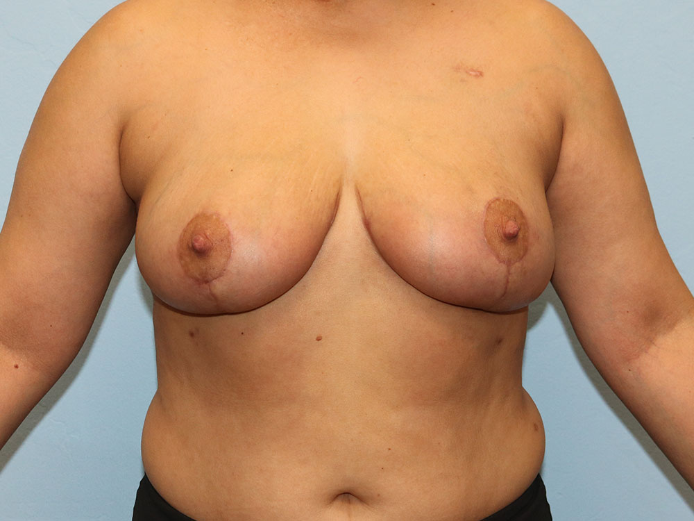 Breast Reduction Before and After | Larson Plastic Surgery