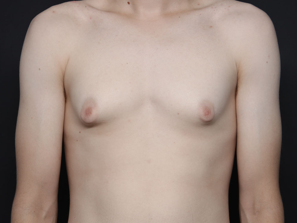 Gynecomastia Before and After | Larson Plastic Surgery