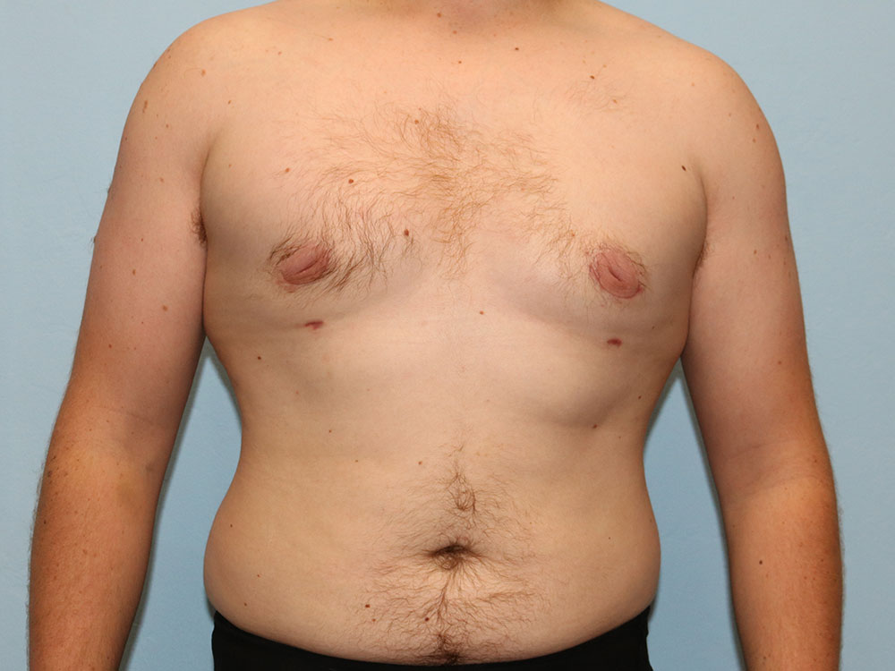 Gynecomastia Before and After | Larson Plastic Surgery