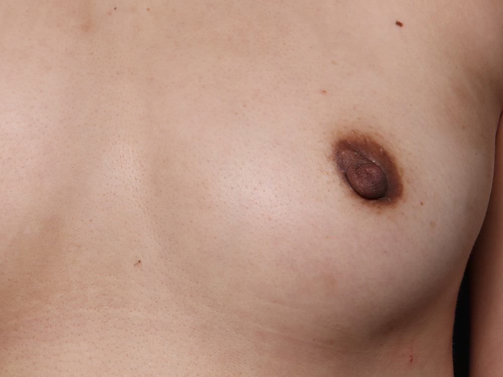Nipple Reconstruction Before and After | Larson Plastic Surgery