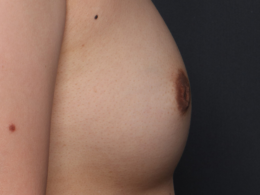Nipple Reconstruction Before and After | Larson Plastic Surgery