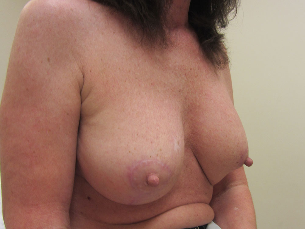 Revision Breast Augmentation Before and After | Larson Plastic Surgery