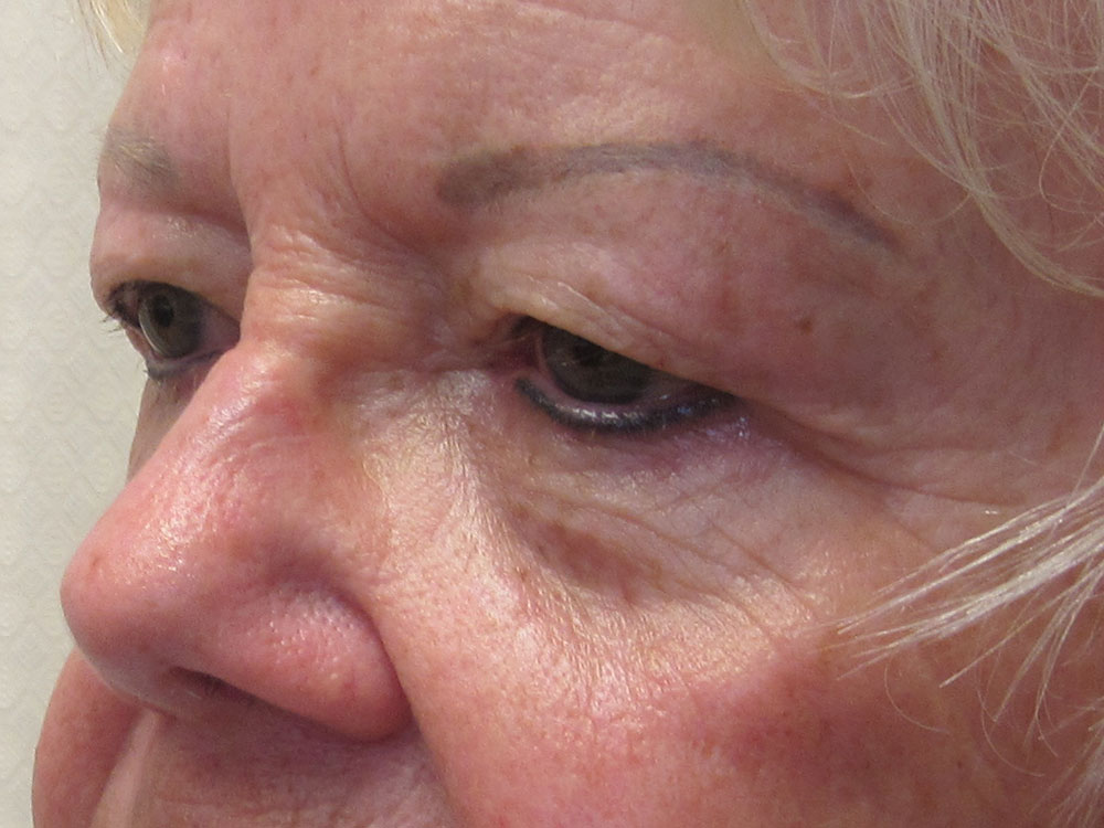 Blepharoplasty Before and After | Larson Plastic Surgery