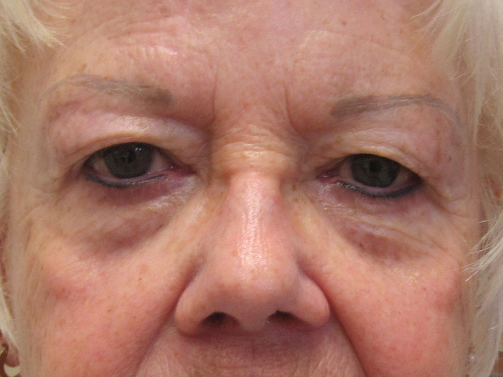 Blepharoplasty Before and After | Larson Plastic Surgery