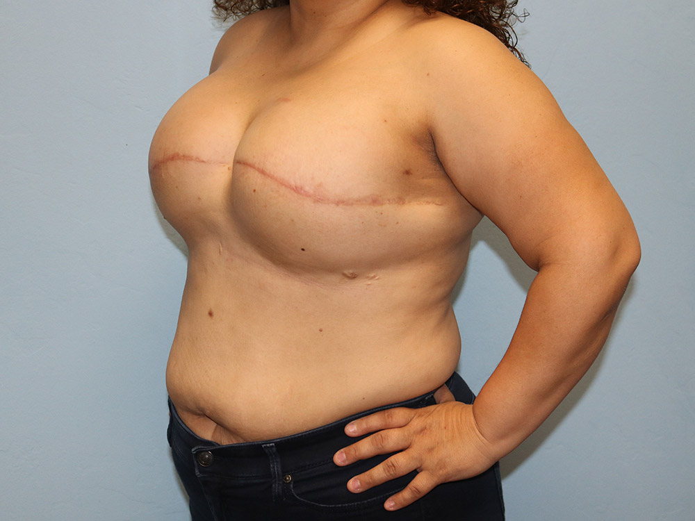 Breast Reconstruction Before and After | Larson Plastic Surgery