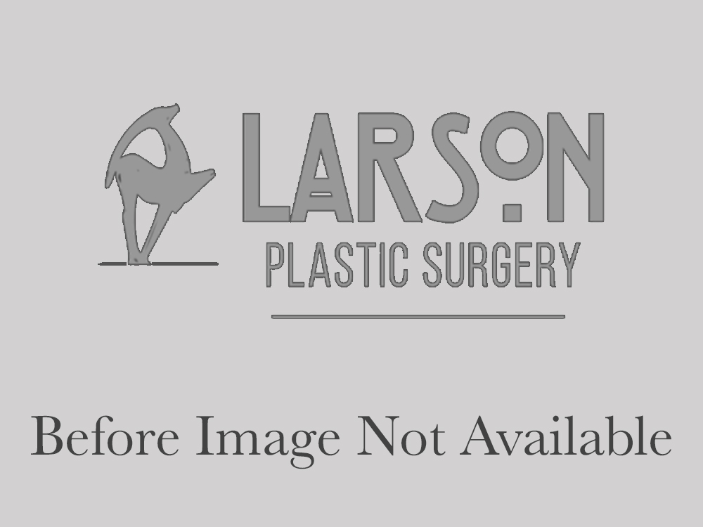 Female To Male Before and After | Larson Plastic Surgery