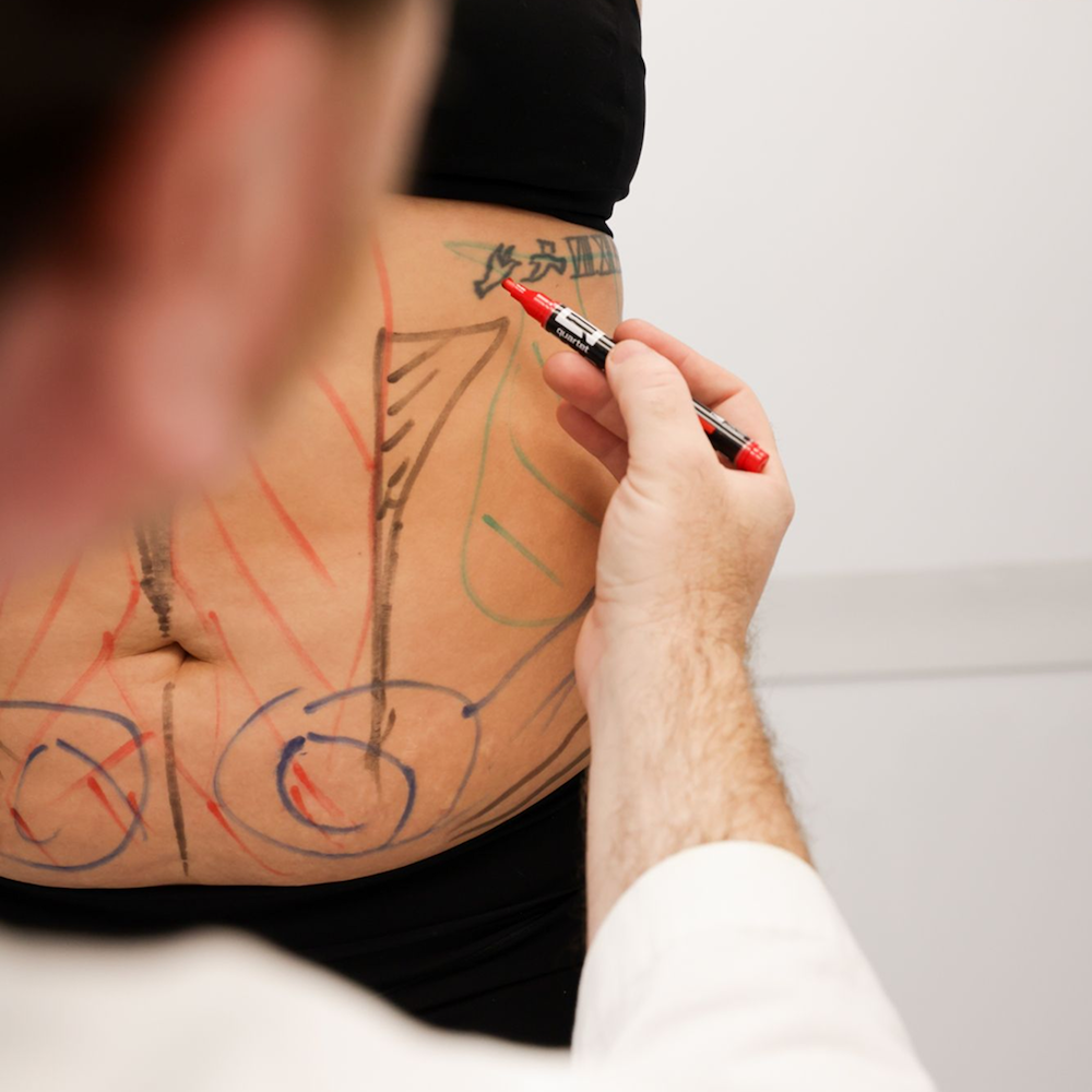 Plastic surgeon holding marker up to patient's stomach, indicating the target areas to address for body contouring in Tucson